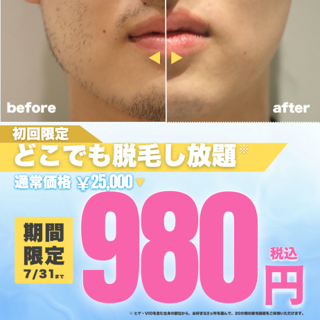\【夏本番】肌見せの季節、ムダ毛ケアはお済みですか?/メンズ脱毛サロン「メンズクリア」初回体験980円!
